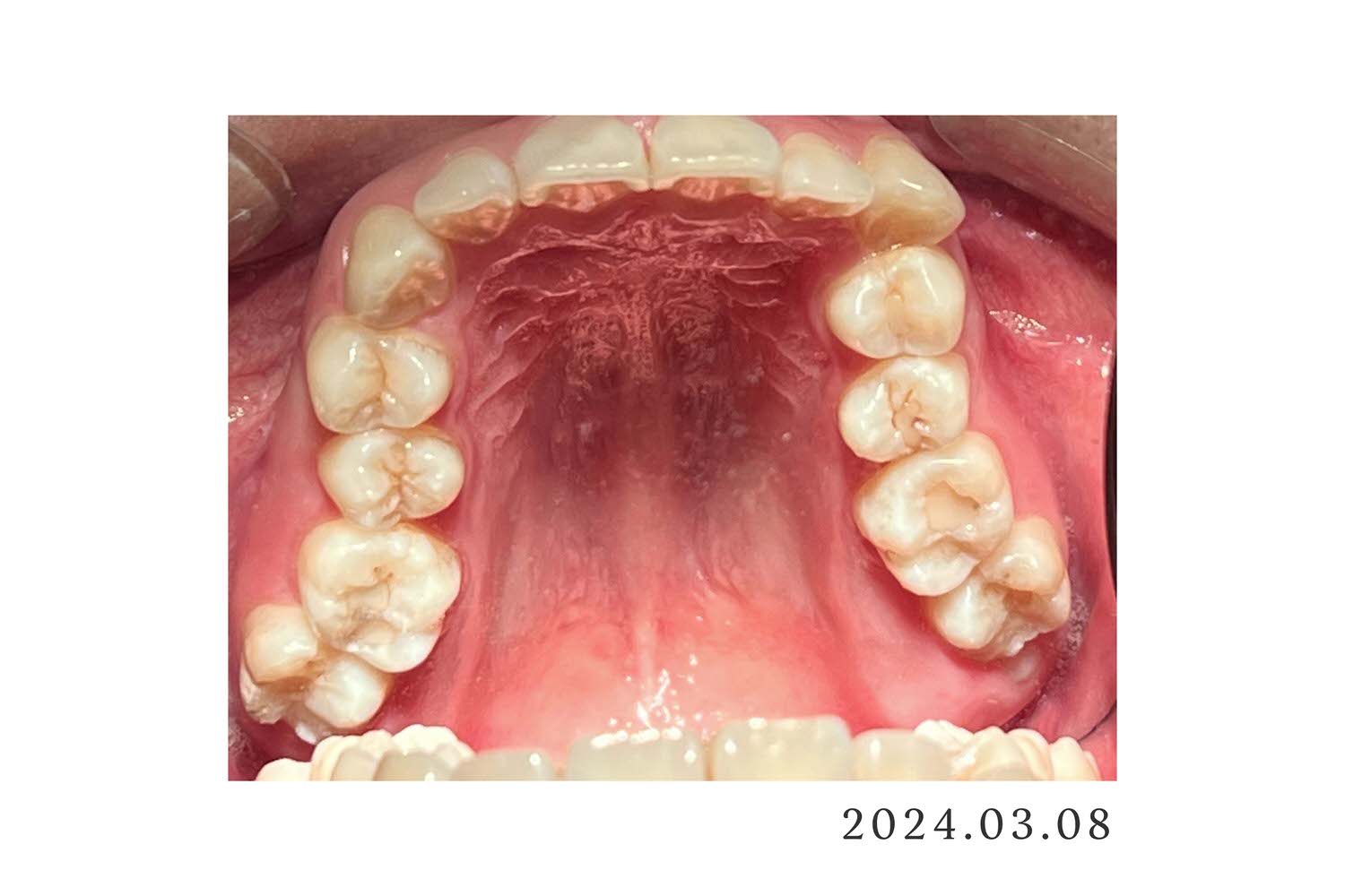 牙套日記1|為什麼要戴牙套?關於我的牙齒情況,看似整齊其實超歪 - 第2張圖
