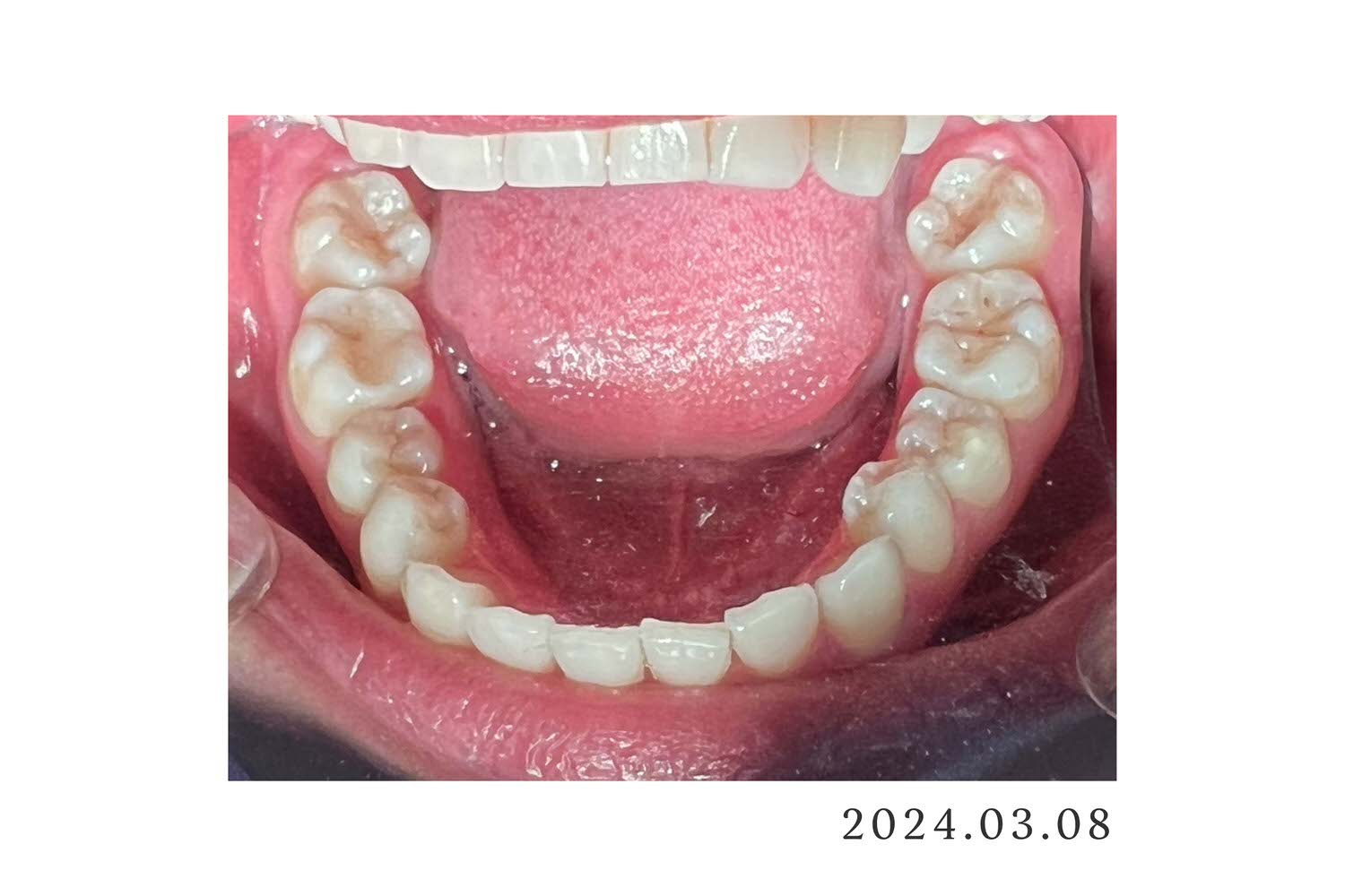牙套日記1|為什麼要戴牙套?關於我的牙齒情況,看似整齊其實超歪 - 第3張圖